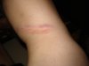 Rope Burn.JPG