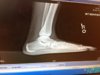 flatfoot.JPG